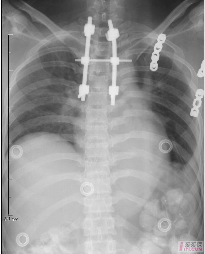 肋膈角锐利,心影形态,大小可;左侧第5-10后内侧肋骨骨折,部分断端轻度