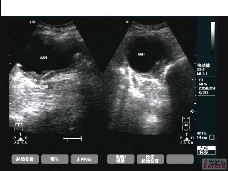 【原创】腹主动脉瘤 - 超声医学讨论版 - 爱爱医医学