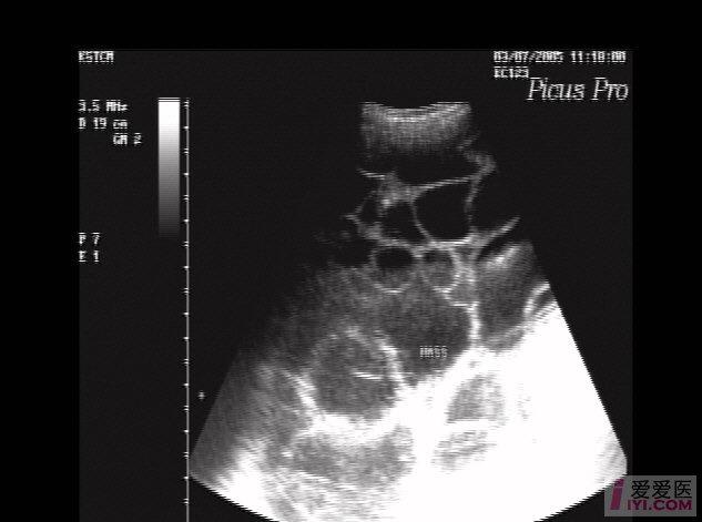 【分享】妊娠合并卵巢多发性黄素囊肿