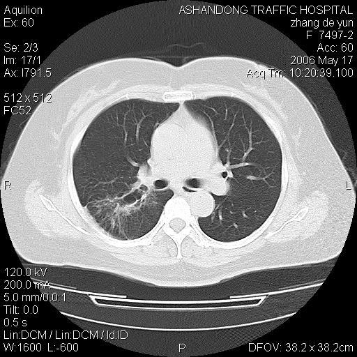 讨论一个少见的肺ct片