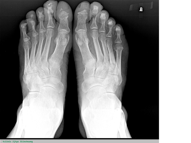 可疑为牛皮癣性关节炎足手