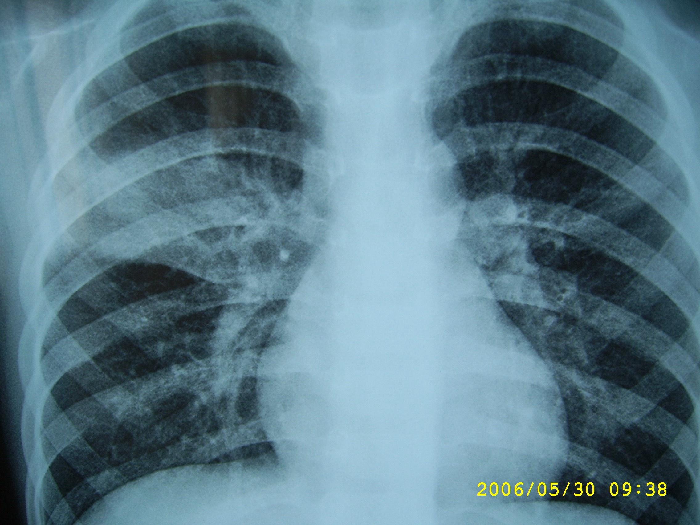 【讨论】右上后段还是右上前段肺炎?