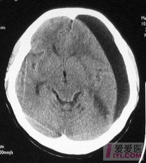 69 【即时求助】拜托ct高手,求见硬膜外及下血肿片硬膜下积液与脑室