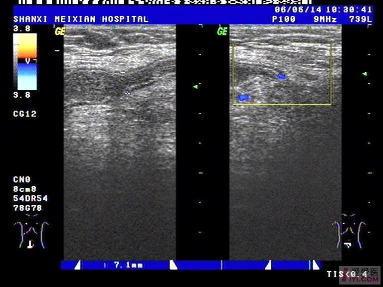 【原创】典型的嵌钝性腹股沟斜疝 - 超声医学讨论版
