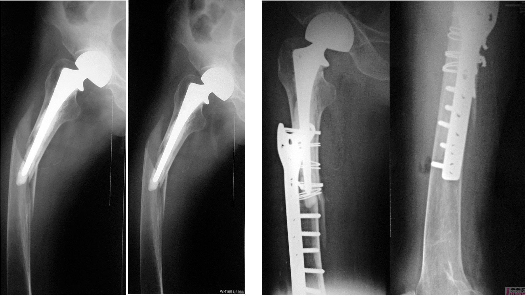 【讨论】股骨头置换术后2年股骨骨折治疗