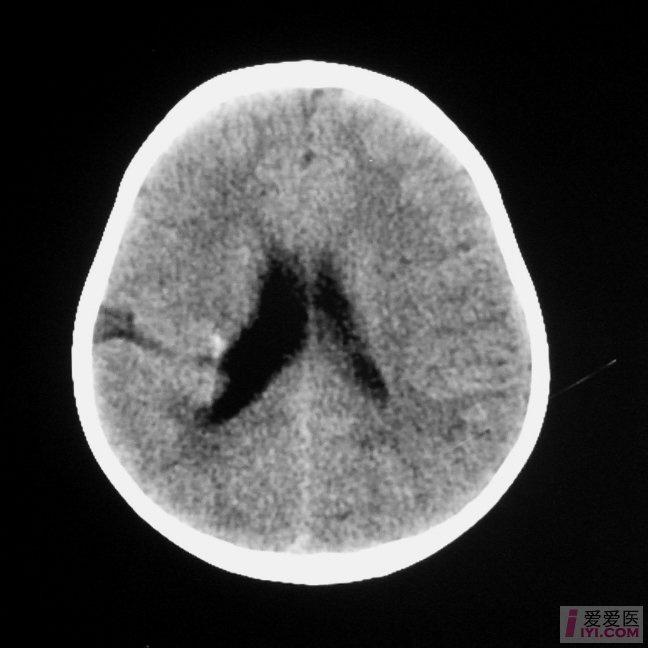 原创颅脑先天畸形典型图片