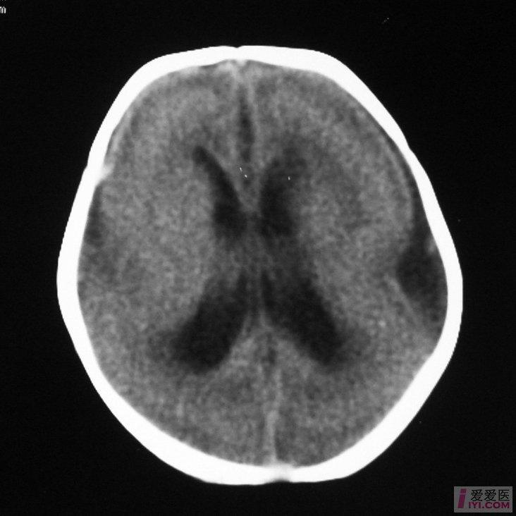 原创颅脑先天畸形典型图片