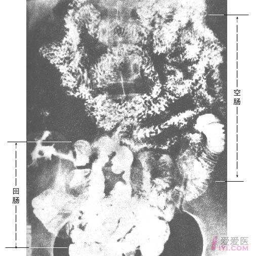 小肠钡餐造影.jpg