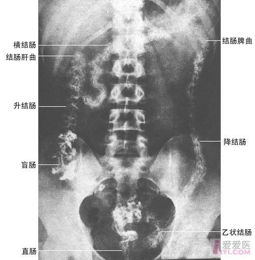 腹部平片(kub 医学影像学讨论版 爱爱医医学论坛