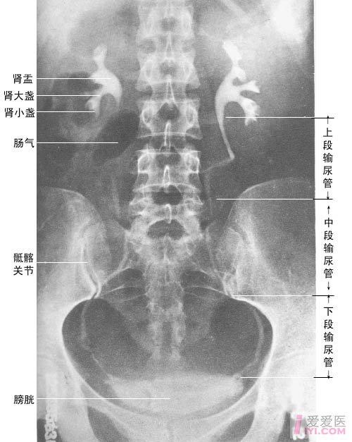 腹部平片kub