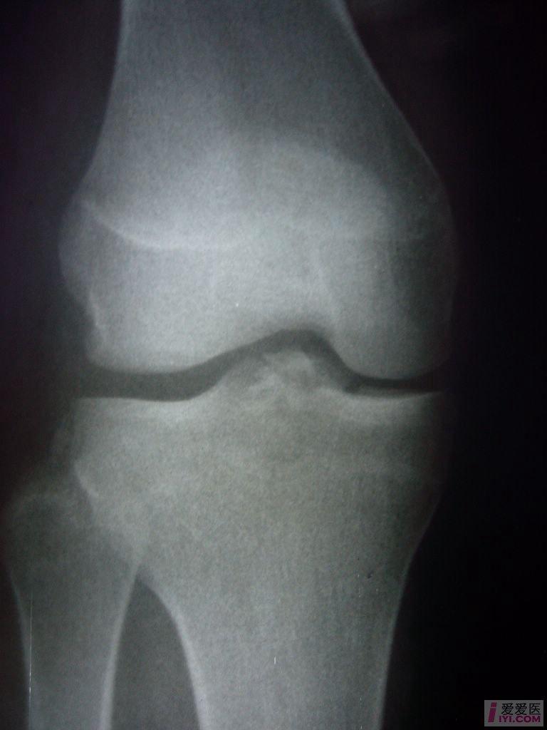 讨论原创右膝关节叉韧带损伤