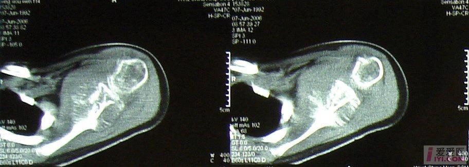 左侧肩胛骨肉瘤一例