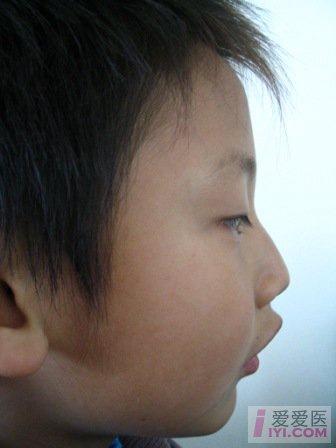 【讨论】上中切牙唇倾下颌后缩
