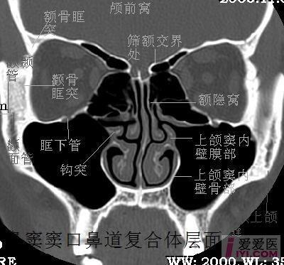 【贴图】经典hrct副鼻窦冠状ct解剖