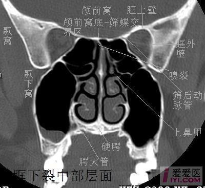 【贴图】经典hrct副鼻窦冠状ct解剖