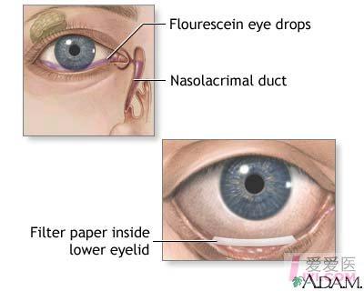 【即时求助】泪囊炎治疗后会复发吗