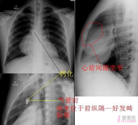 值得仔细分析的胸片dr