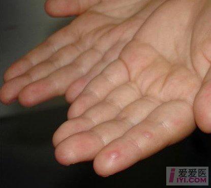 2:肠道病毒感染 现在已经发现多种肠道病毒,多见柯萨奇病毒,其中