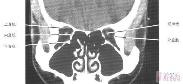 眼眶ct冠状面(眶尖部层面)