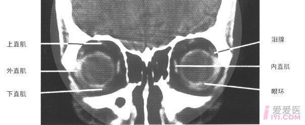 眼眶ct冠状面(眶前部层面)