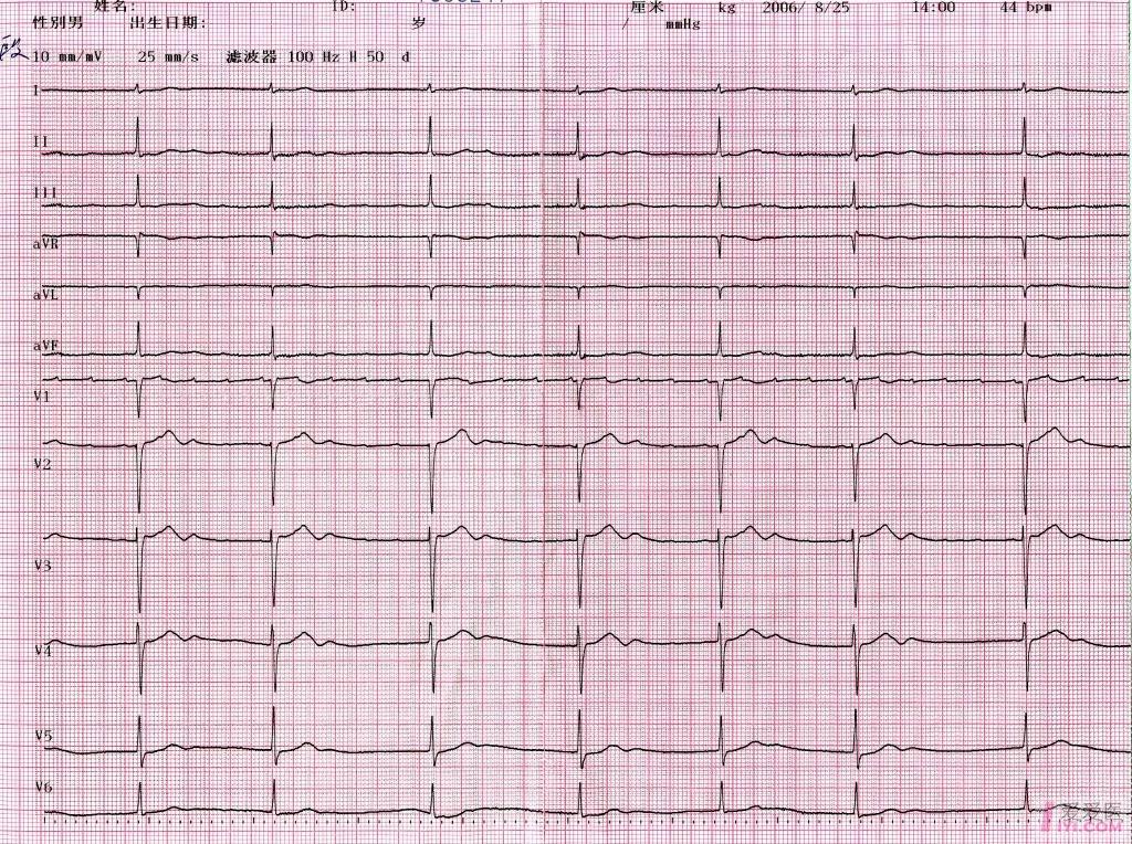 心电图一例