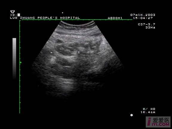 【贴图】急性阑尾炎的声像图表现 - 超声医学讨论版