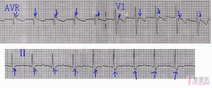 【原创】心律失常 心电图脑电图专业讨论版 爱爱医医学论坛