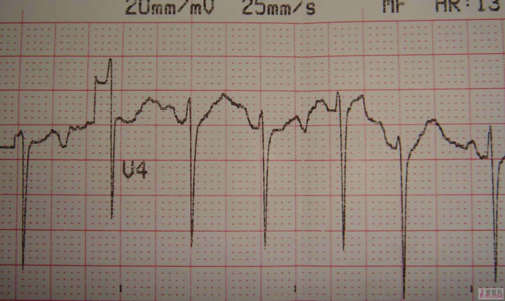求助诊断?(奇怪心电图)