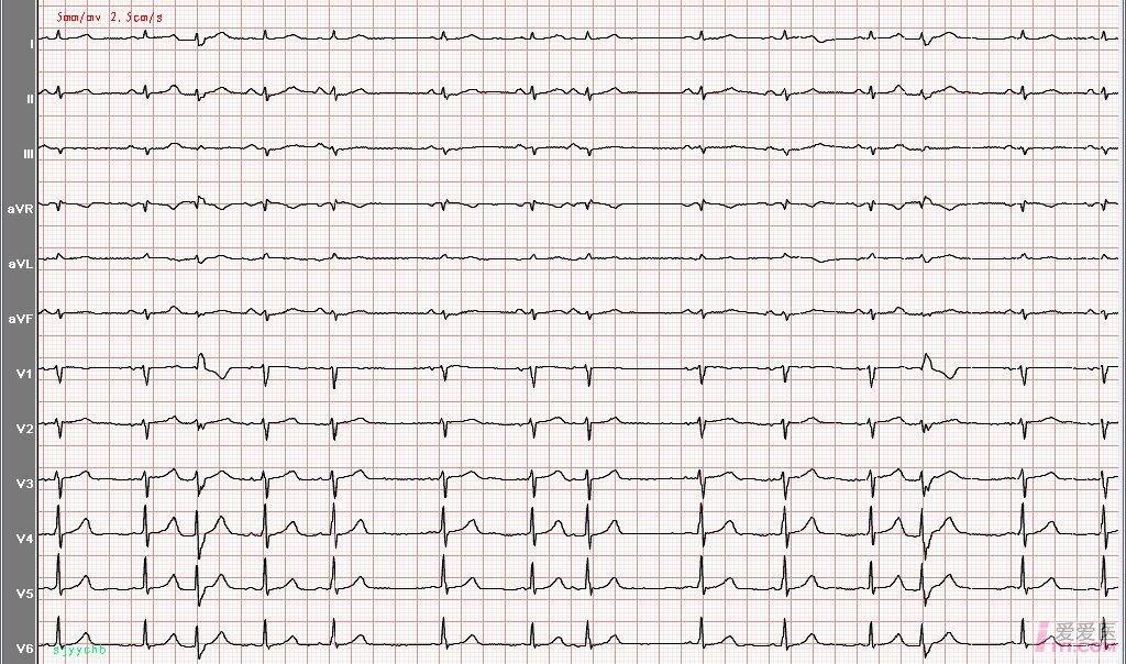 心电图学习20060904频发房性早搏,部分伴差传,短阵非阵发性房速反复