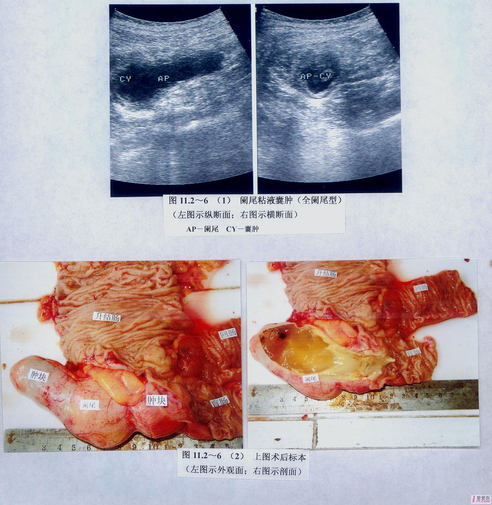 阑尾囊肿.jpg