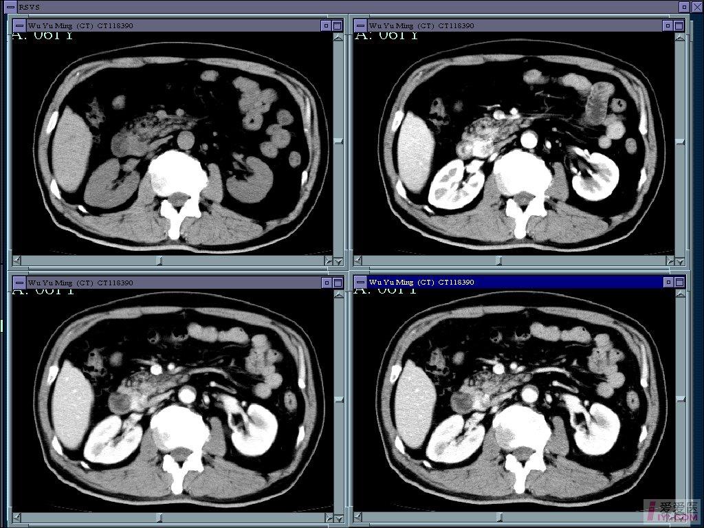原创十二指肠间质瘤的ct四期通览图