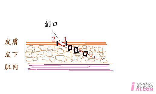 面部外伤的整形缝合什么情况下应用z字成型