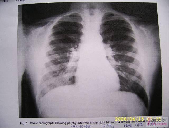 右肺门斑片影和弥漫间质影