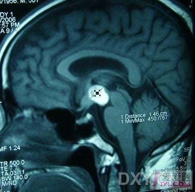病例讨论鞍上池出血占位