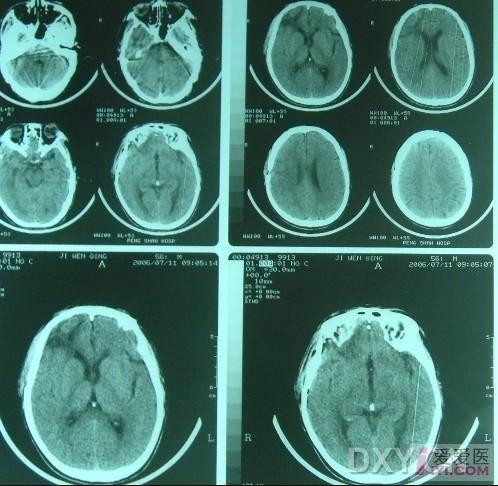 病例讨论鞍上池出血占位