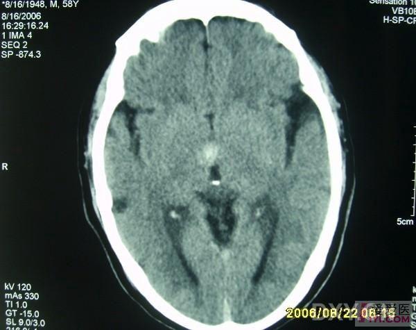 病例讨论鞍上池出血占位