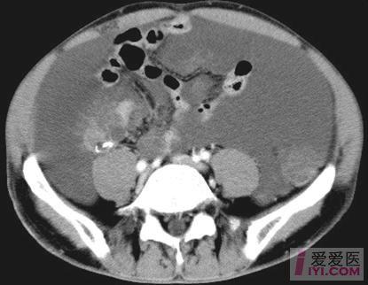 原创腹膜假性粘液瘤一例ct