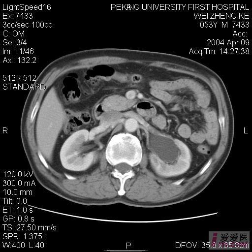 原创膀胱癌并左输尿管下端受侵ct图片