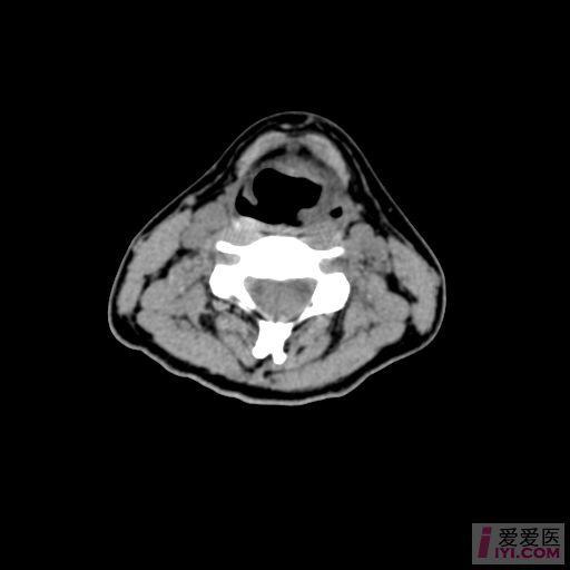 原创喉部ct