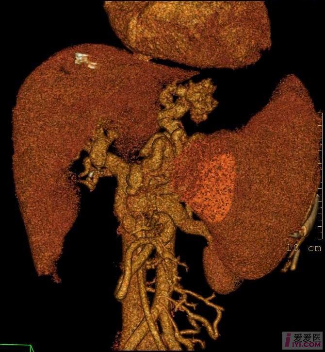 门脉海绵变性-门脉高压(64ct三维,直观漂亮)