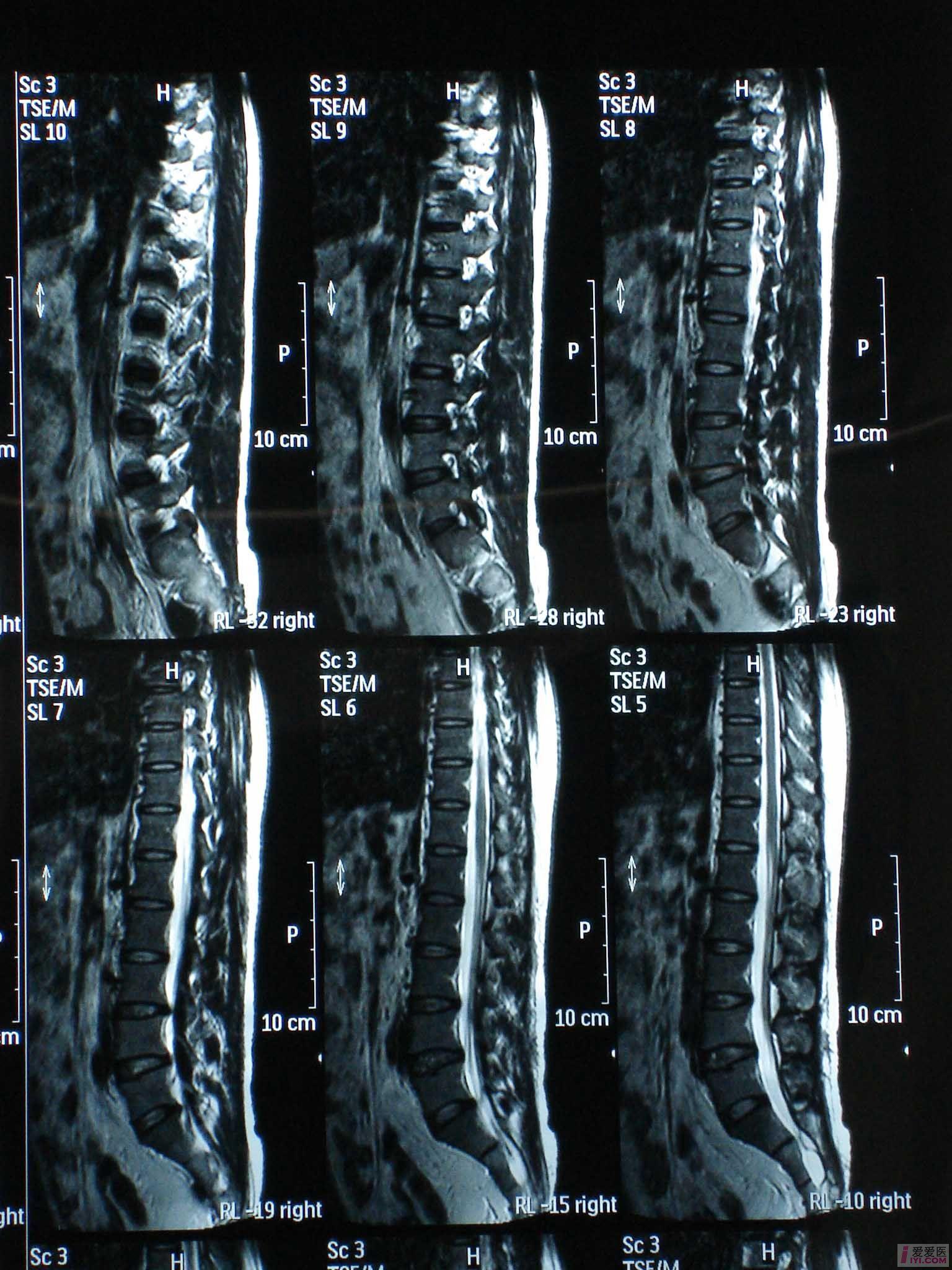 【即时求助】这位患者的腰椎及椎间盘有病变吗?