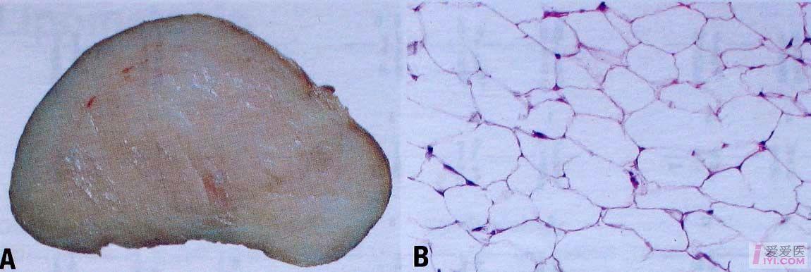 【资源】(2002)who肿瘤病理学分类-----脂肪细胞性肿瘤
