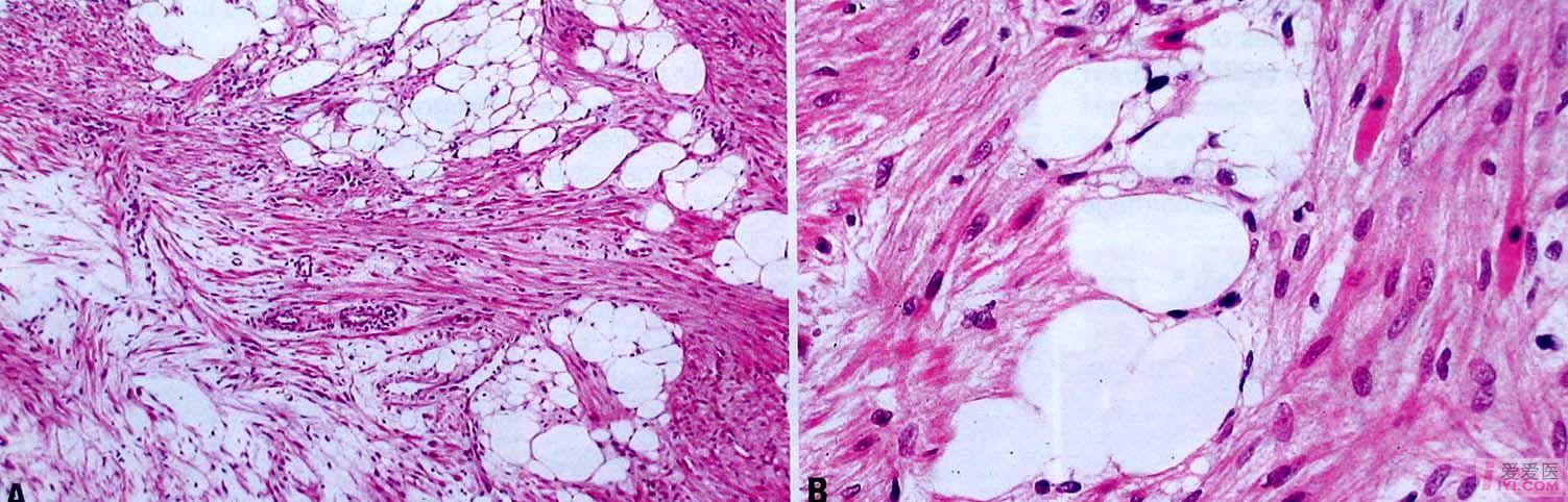 【资源】(2002)who肿瘤病理学分类-----脂肪细胞性肿瘤