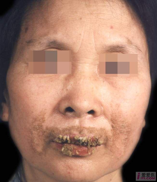 皮肤黏膜念珠菌感染图片