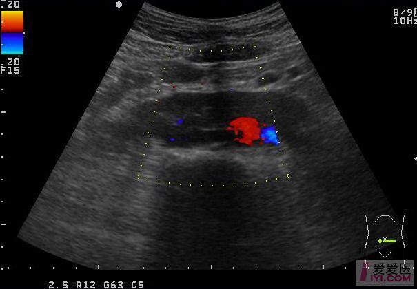 【原创】典型马蹄肾一例 - 超声医学讨论版 - 爱爱医