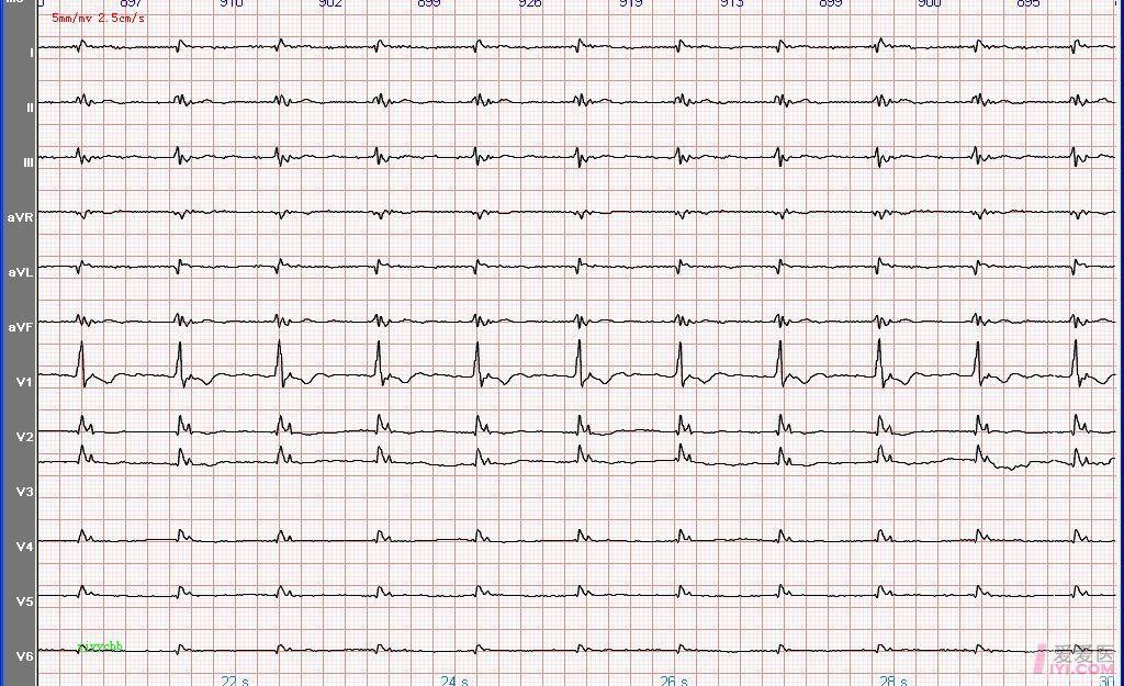 【原创】心电图学习200612031,右位心 2,非阵发性交界性心动过速 3