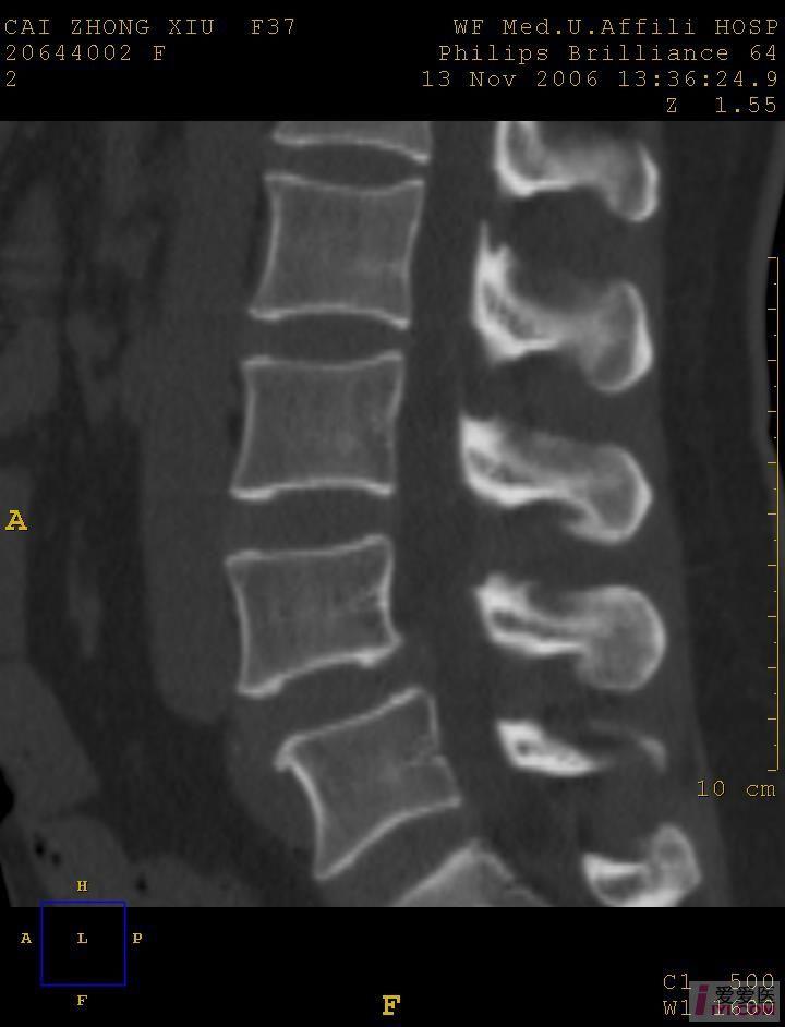 分享典型病例椎弓崩裂患者影像图片