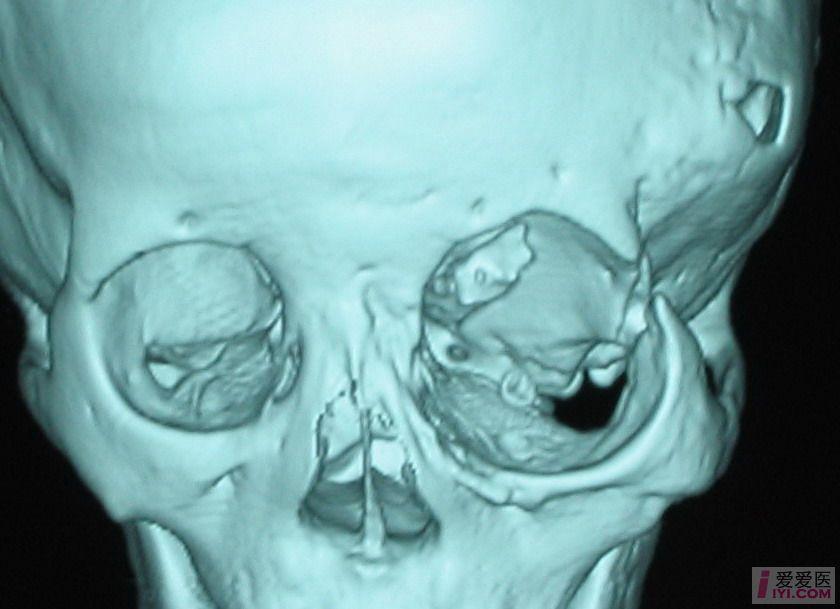 原创颅骨眶内遭受侵犯的神经纤维瘤疑难病例经典治疗