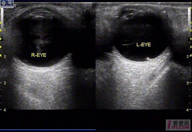 [原创]视网膜脱落 - 超声医学讨论版 - 爱爱医医学论坛