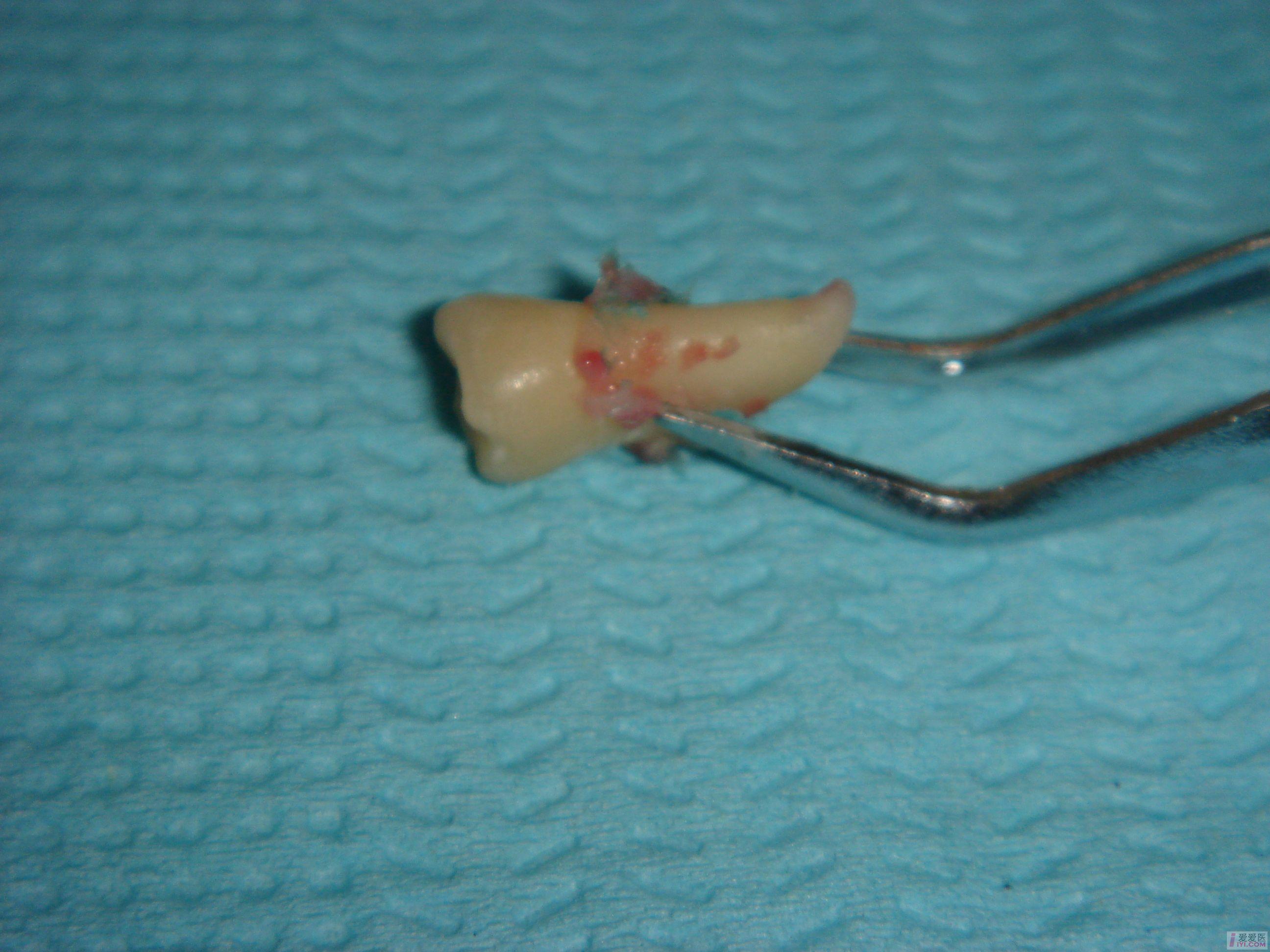 【原创】讨论 比较少见的下颌多生牙(有图 口腔医学专业讨论版